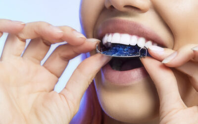 Should You Pack Your Retainer for College?