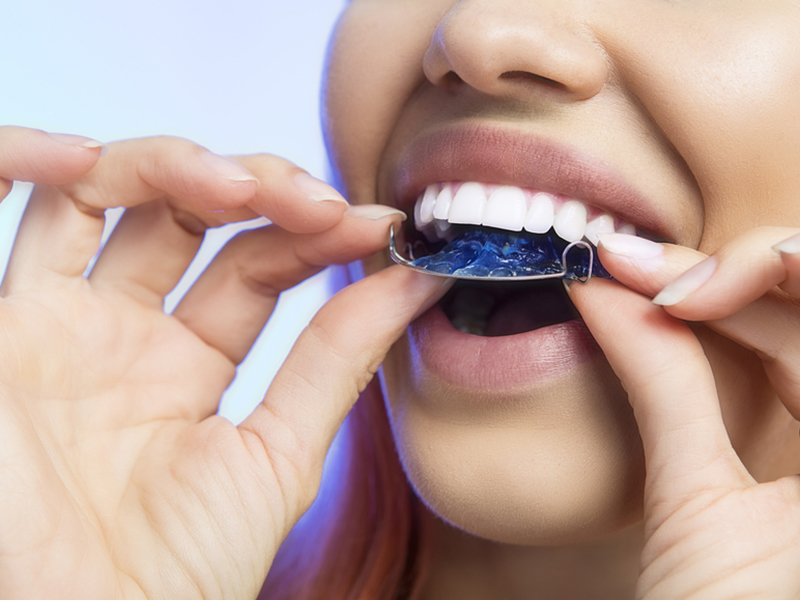 Should You Pack Your Retainer for College?